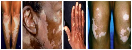 vitiligo cure