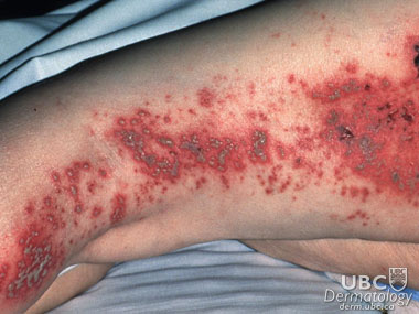 herpes zoster 1